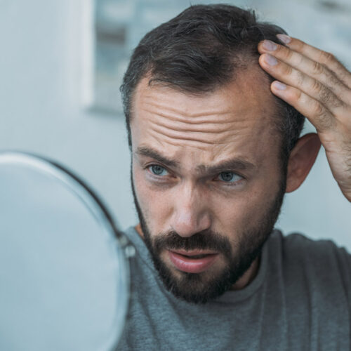 Mann-Geheimratsecken1200 Mann Haarpigmentierung